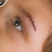 Does My Child Need Stitches?