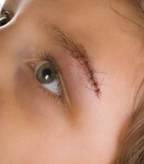 Does My Child Need Stitches?